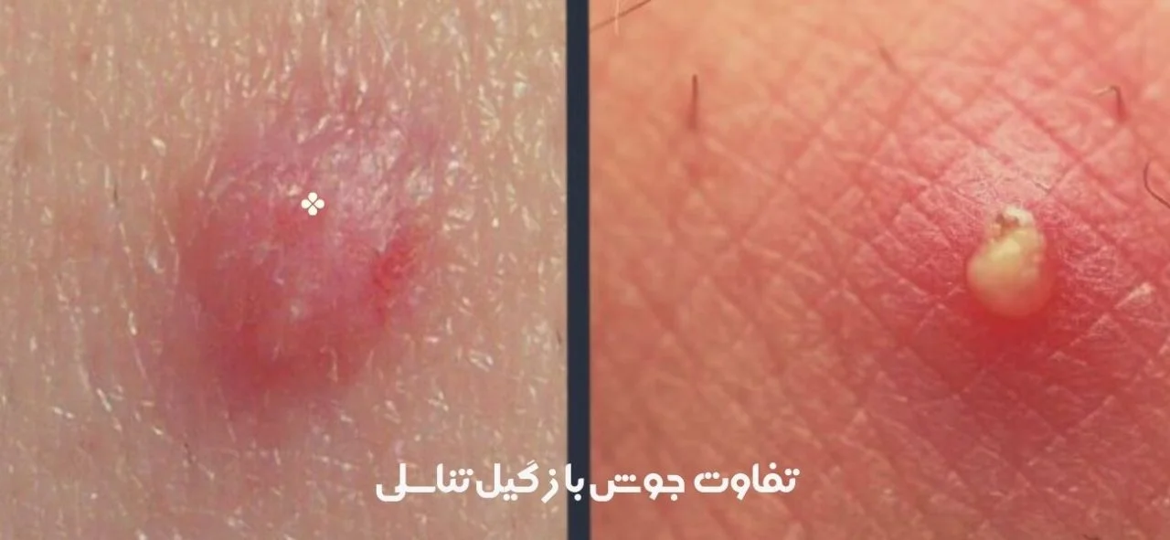 فرق زگیل مقعدی با جوش