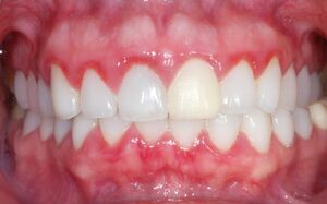 بررسی علل خارش لثه