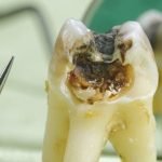 سیاه شدن دندان