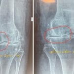 0 تا 100 سلول درمانی برای زانو را بدانید