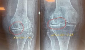 0 تا 100 سلول درمانی برای زانو را بدانید