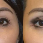 ایا فیلر زیر چشم باعث کوچک شدن چشم میشود