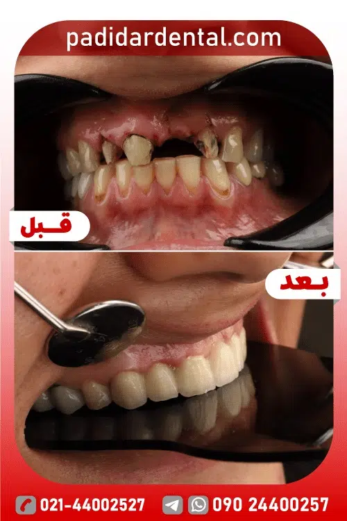قبل و بعد ایمپلنت دندان