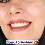 انجام لمینت دندان در شیراز
