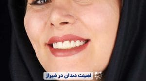 انجام لمینت دندان در شیراز