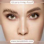 کاشت ابرو بدون جراحی