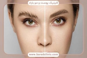 کاشت ابرو بدون جراحی