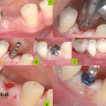 ایمپلنت بدون جراحی : ایمپلنت دیجیتال، ایمپلنت پانچ