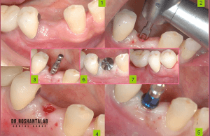 ایمپلنت بدون جراحی : ایمپلنت دیجیتال، ایمپلنت پانچ
