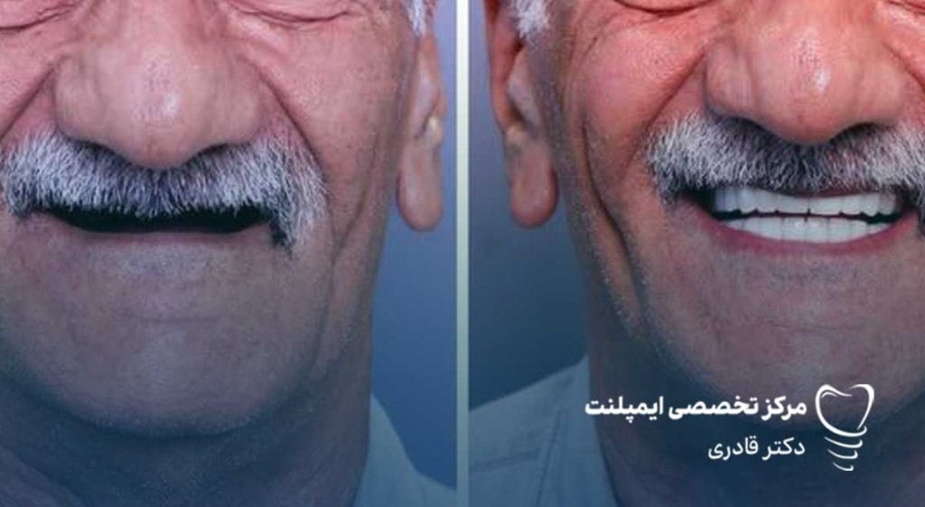 C:\Users\zahra\Desktop\عکس-نمونه-کار-ایمپلنتییی-1024x561.jpg