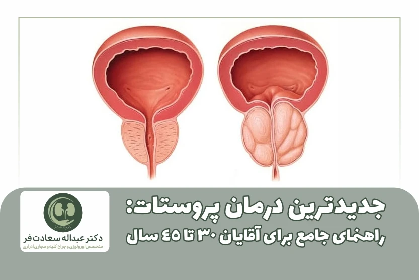 جدیدترین درمان پروستات: راهنمای جامع برای آقایان ۳۰ تا ۴۵ سال