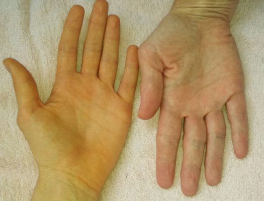 چگونه بفهمیم نارسایی کبد داریم؟/ دلیل زرد شدن سفیدی چشم