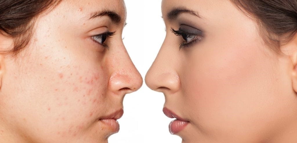 پاکسازی پوست چیست و چگونه انجام می شود؟ - تابناک | TABNAK