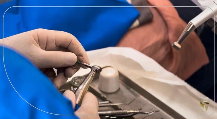 مزایای ایمپلنت دیجیتال: از دقت تا راحتی بی‌نظیر