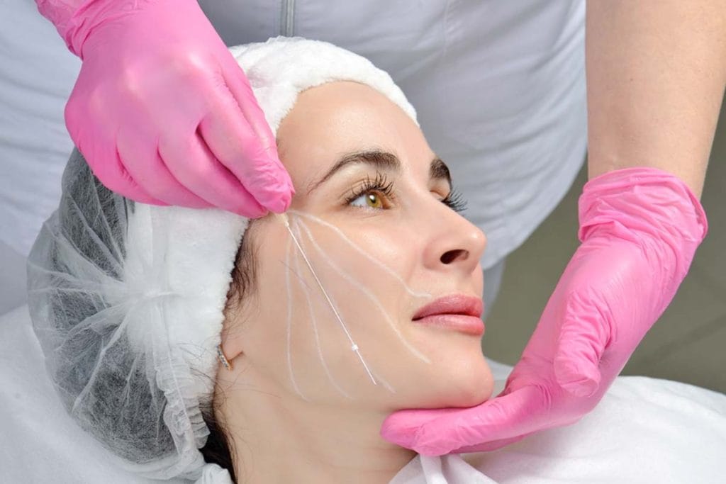 لیفت صورت با نخ آپتوس: روشی نوین برای جوانسازی طبیعی با دکتر فرزان نقشوار