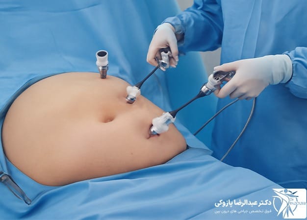 تکنیک‌های جدید کاهش وزن