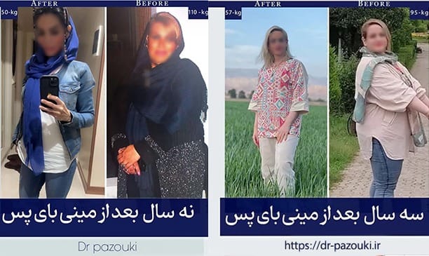 نمونه کارهای جراحی چاقی توسط دکتر پازوکی