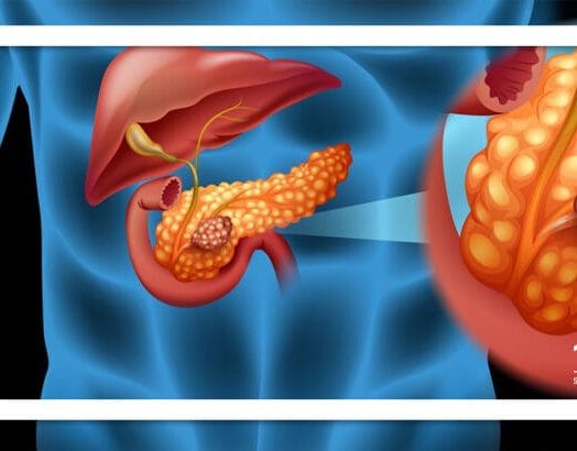 میکروب‌های دهان و خطر سرطان پانکراس: یک ارتباط جدید در پژوهش‌ها