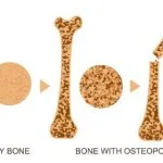 کشک خشک بمب کلسیم است/ این گونه مصرف کنید تا سنگ کلیه نگیرید