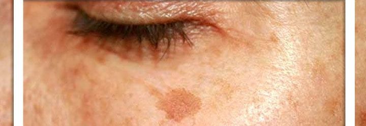 چرا تشخیص لک پوستی اهمیت دارد؟