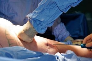 Liposuction: Uses, benefits, and risks