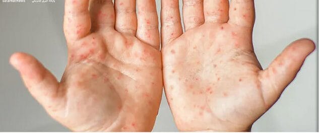 تب برفکی: بیماری ایمن از انتقال به انسان / نظارتهای دقیق دامپزشکی محصولات آلوده را از بازار خارج میکند