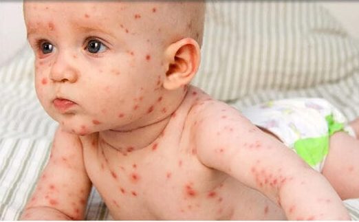 شایع‌ترین بثورات ویروسی در نوزادان +عکس