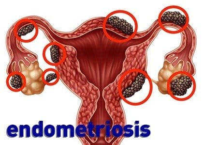 محل های درگیری رحم و تخمدانها در آندومتریوزیس