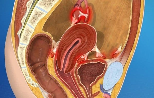 علایم آندومتریوز