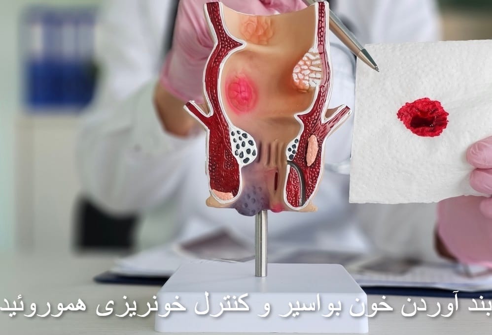 بواسیر خونی