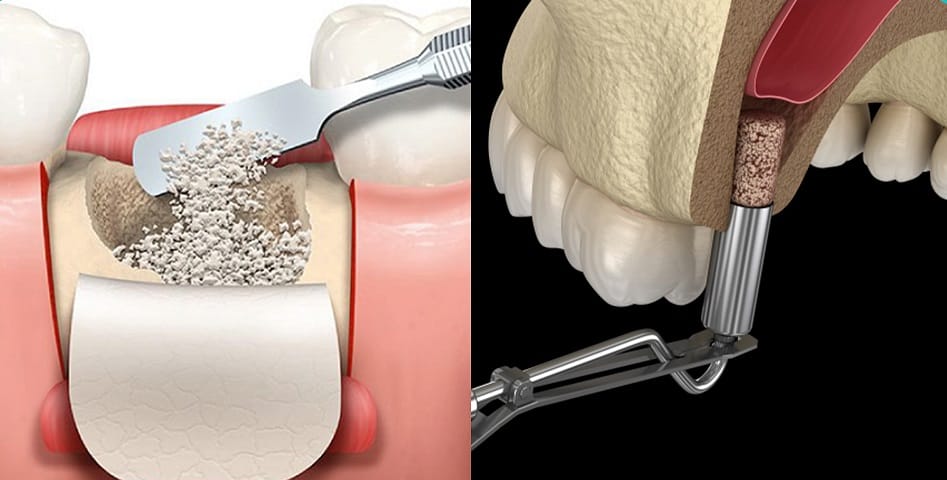هزینه مواد زیستی ایمپلنت در ایران و مقایسه برندهای ایرانی و خارجی