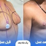 آیا ورزش می‌تواند بزرگی سینه مردان را درمان کند؟