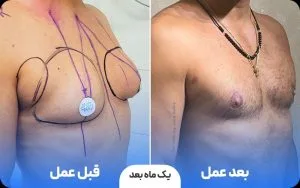 آیا ورزش می‌تواند بزرگی سینه مردان را درمان کند؟