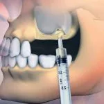 هزینه مواد زیستی ایمپلنت در ایران و مقایسه برندهای ایرانی و خارجی