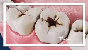 شایع‌ترین علت پوسیدگی دندان چیست؟