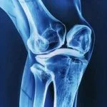 معجزه زردچوبه و زنجبیل برای ایمپلنت استخوان