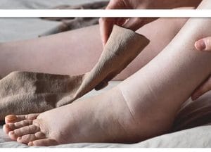 ورم ناگهانی پا را جدی بگیرید