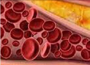 بالا رفتن تری‌گلیسرید در بدن چه خطری دارد؟