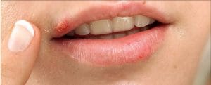 وقتی تبخال کودکی در بزرگسالی دردسری جدی درست می‌کند