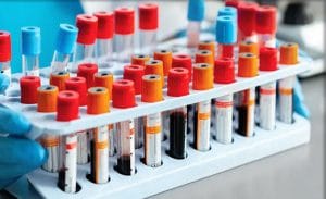 تاثیر آزمایش خون مبتنی بر DNA بر درمان سرطان گلو
