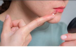سرطان پوست؛ روش‌های پیشگیری، تشخیص زودهنگام و درمان
