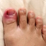 علل و نشانه های بروز عفونت ناخن پا