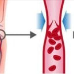 لخته شدن خون در پا را جدی بگیرید