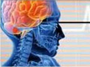 تحریک نخاع به بازیابی قدرت بازو پس از سکته مغزی کمک می کند