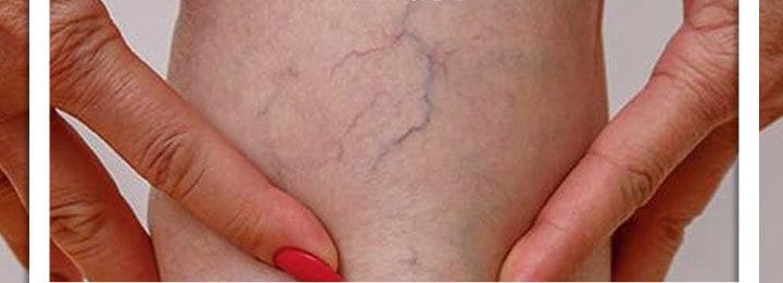 توصیه مهم برای پیشگیری از «واریس»