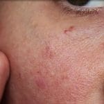 عوارض پوستی داروهای لاغری GLP-۱ از زبان متخصصان پوست
