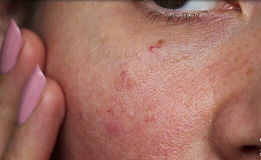 عوارض پوستی داروهای لاغری GLP-۱ از زبان متخصصان پوست