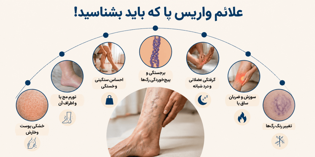 واریس و بی حسی پا