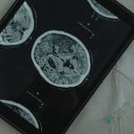 هورمون استرس ممکن است به ترمیم مغز کمک کند؛ چه چیزهایی باید درباره نقش CRH در بازسازی میلین بدانیم