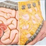 آمار خطرناک چربی خون ایرانی‌ها